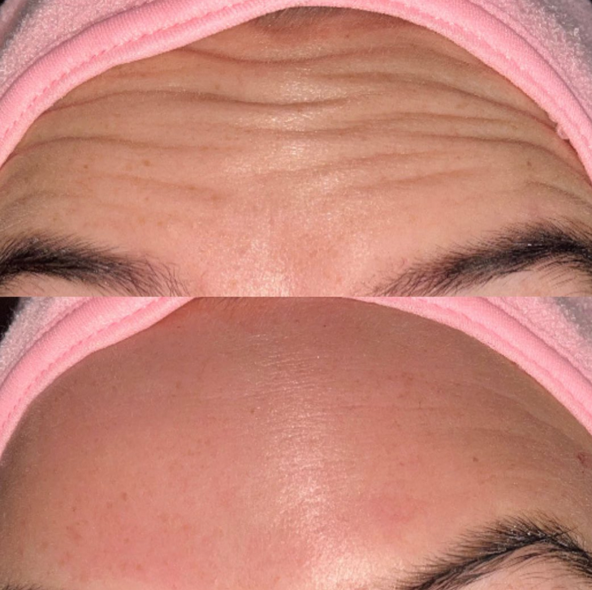 Anti-Wrinkle Injectable