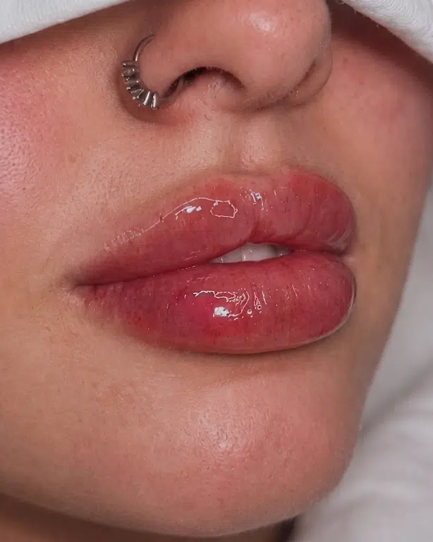 Lip Filler