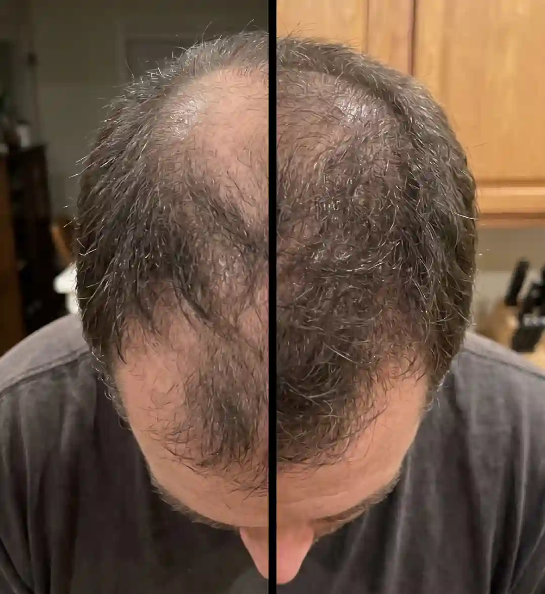 Hair Growth