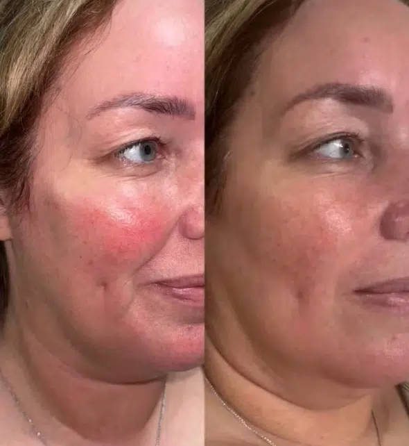 Cheek Sculpt